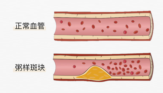 血栓是心梗、腦梗的元兇，很容易找上這些人