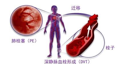 骨科術(shù)后重點(diǎn)關(guān)注的問題—VTE，該如何防治？