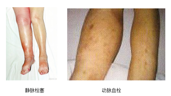 動(dòng)脈血栓和靜脈血栓有什么區(qū)別嗎？