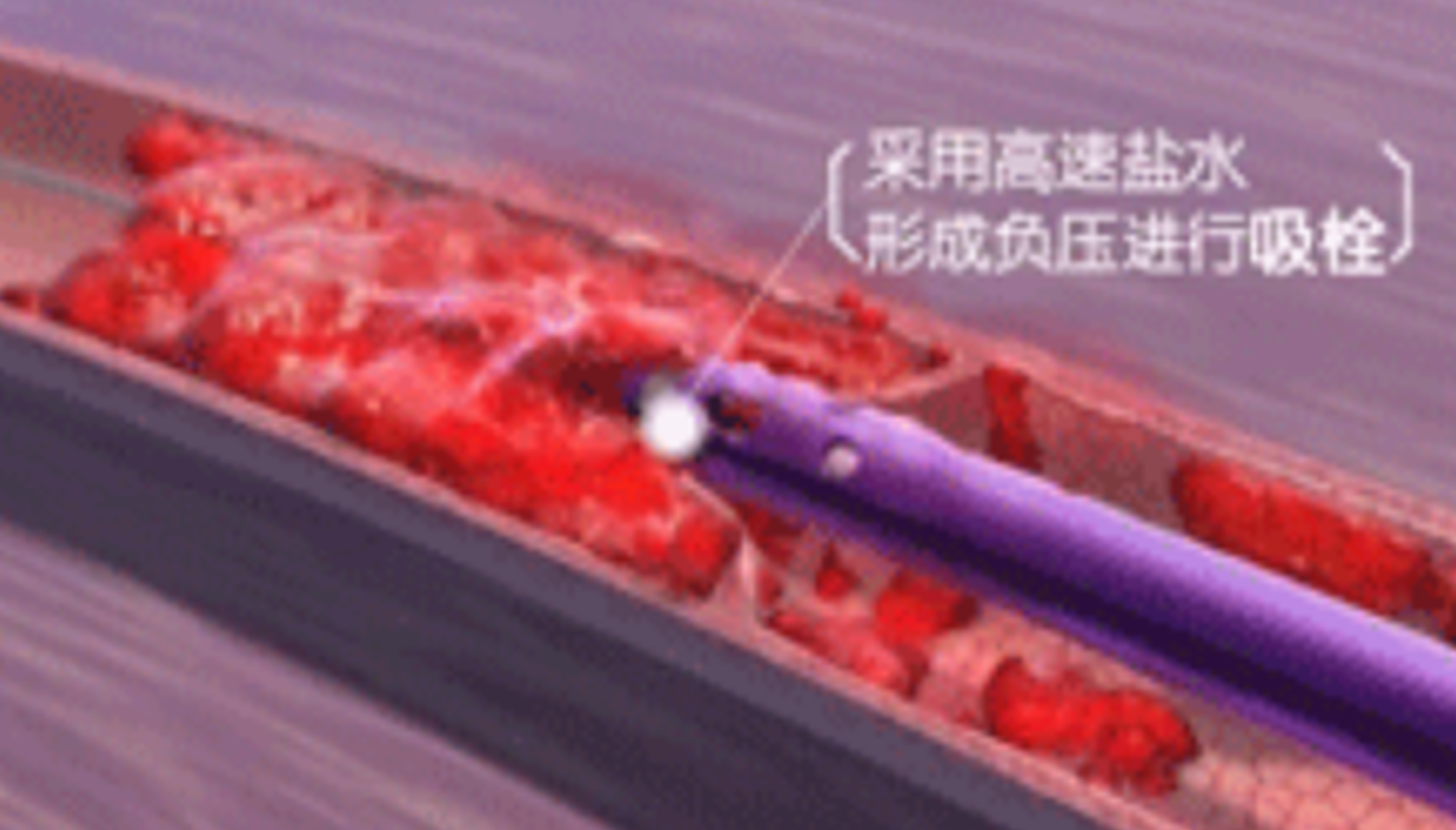 深靜脈血栓能致命，防治“大法”要了解！