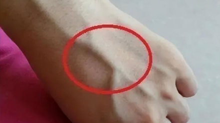 有人手臂上“青筋暴起”，有人卻看不到“青筋”，這是咋回事？