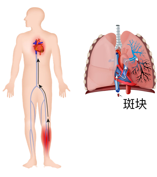 血栓是心梗、腦梗的元兇，很容易找上這些人