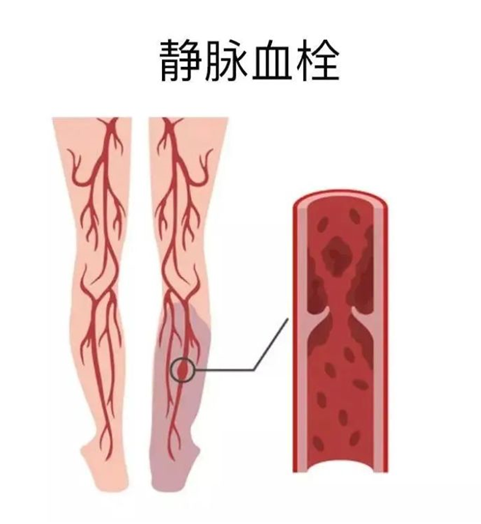 血栓是心梗、腦梗的元兇，很容易找上這些人
