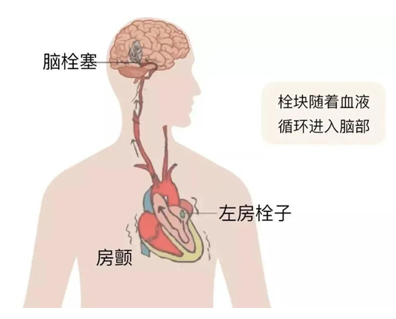 血栓是心梗、腦梗的元兇，很容易找上這些人