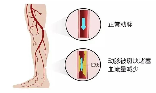 血栓是心梗、腦梗的元兇，很容易找上這些人