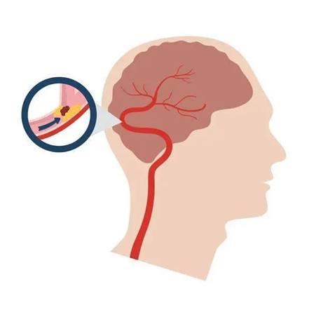 血栓是心梗、腦梗的元兇，很容易找上這些人