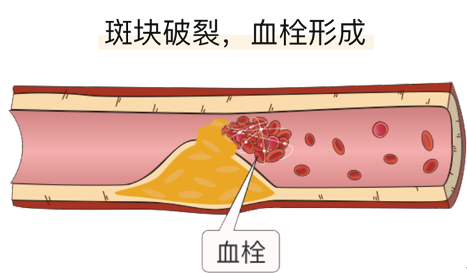 血栓是心梗、腦梗的元兇，很容易找上這些人