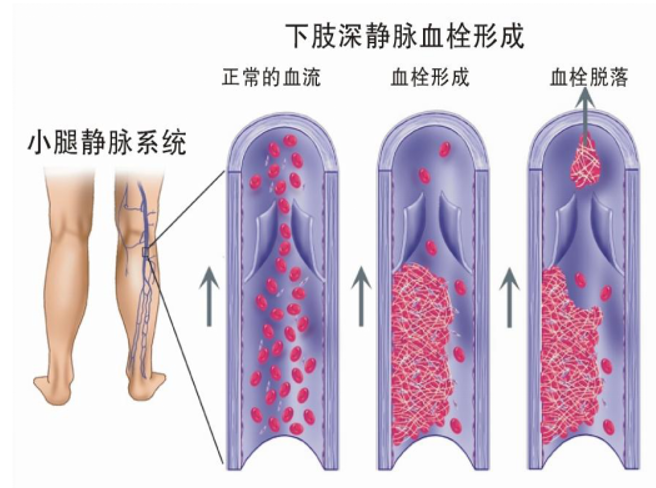 警惕！這個(gè)全球“第三大心血管殺手”，我們?cè)撊绾螒?yīng)對(duì)？