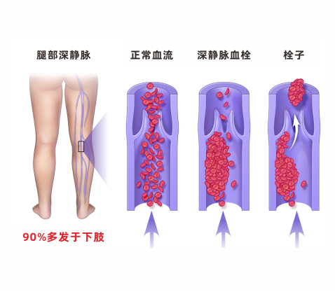 深靜脈血栓類似病癥的認(rèn)識(shí)與區(qū)分