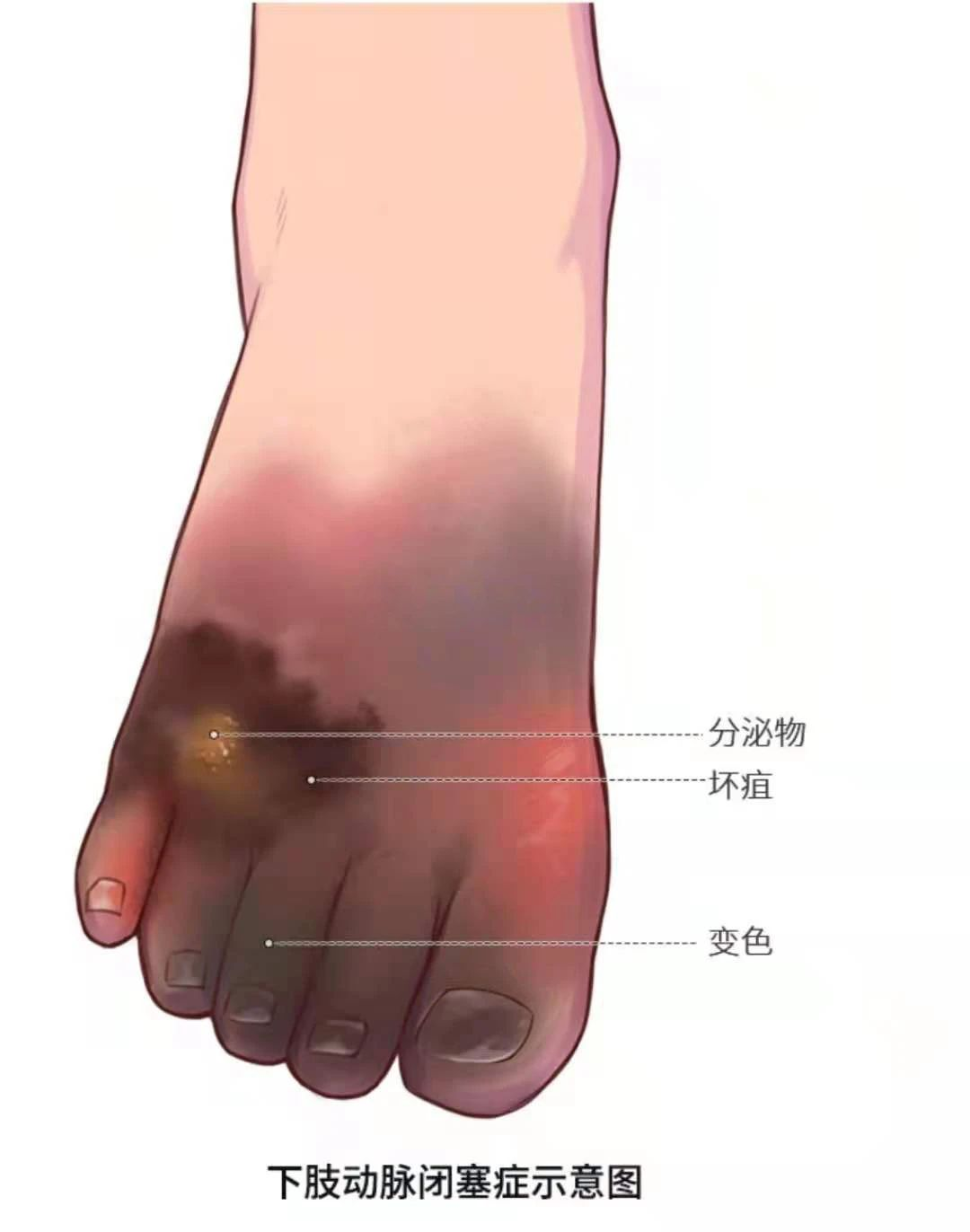 深靜脈血栓類似病癥的認(rèn)識(shí)與區(qū)分
