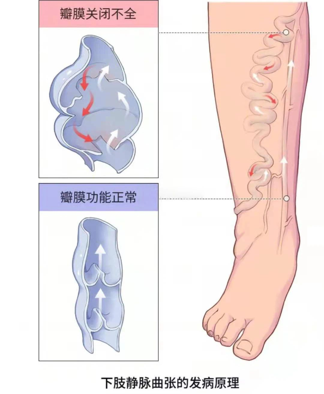 深靜脈血栓類似病癥的認(rèn)識(shí)與區(qū)分