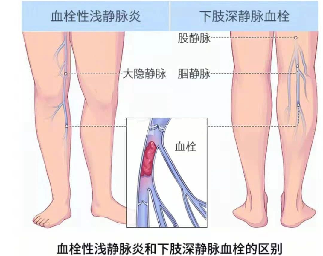 深靜脈血栓類似病癥的認(rèn)識(shí)與區(qū)分