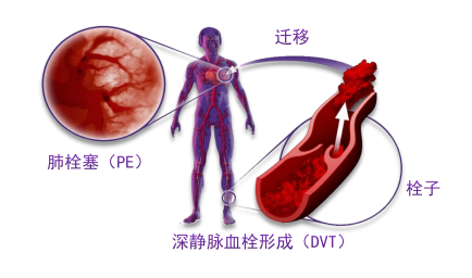 骨科術(shù)后重點(diǎn)關(guān)注的問(wèn)題—VTE，該如何防治？