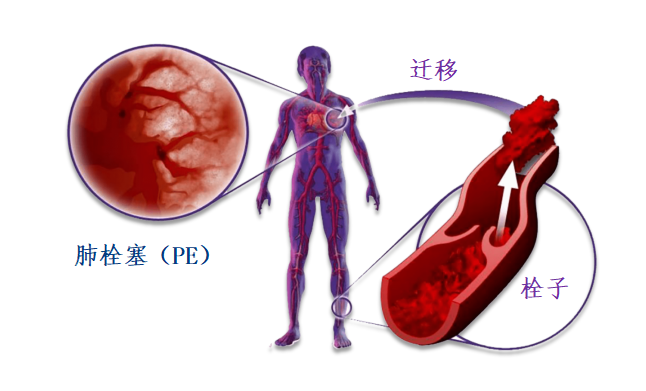 動(dòng)脈血栓和靜脈血栓有什么區(qū)別嗎？