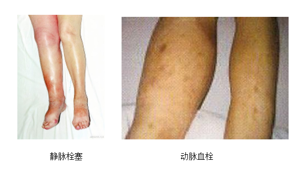動(dòng)脈血栓和靜脈血栓有什么區(qū)別嗎？