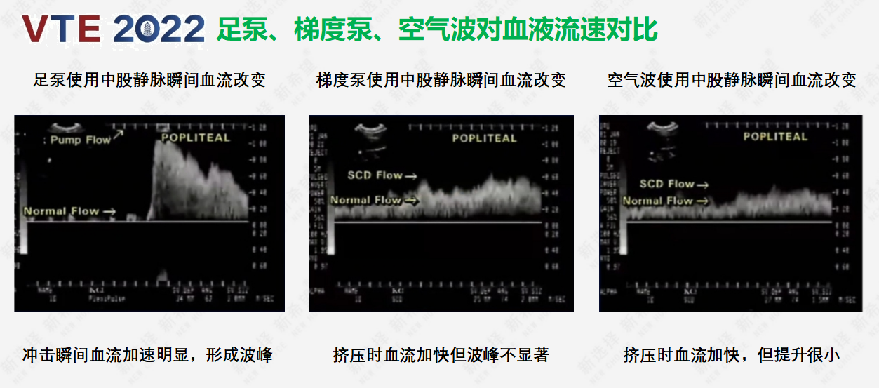 圍術(shù)期患者VTE的預(yù)防，只知道抗凝可不行