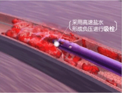 深靜脈血栓能致命，防治“大法”要了解！