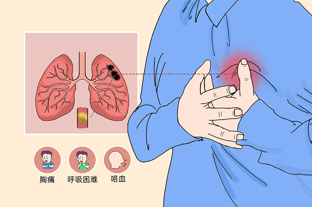 VTE的危害您了解嗎？