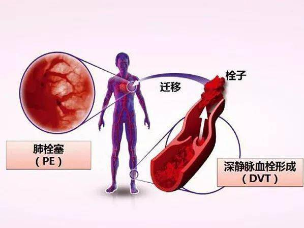 靜脈血栓栓塞癥（VTE）||經(jīng)濟(jì)艙綜合癥