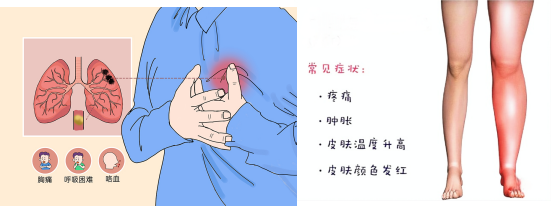 腦梗與深靜脈血栓：不可忽視的血管危機(jī)